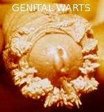 изображение генитальной кондиломы